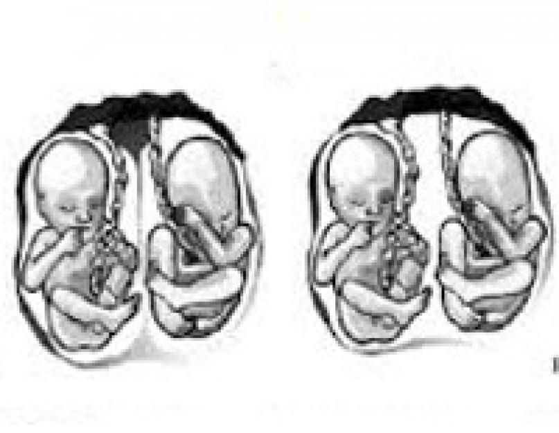 Многоплодная беременность - ведение. Многоплодная беременность: период особого положения Ведение многоплодной беременности в женской консультации