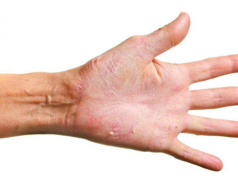 Почему трескается кожа на пальцах около ногтей. Мазь от трещин на руках с заживляющим эффектом. Предупреждение трещин на коже возле ногтей