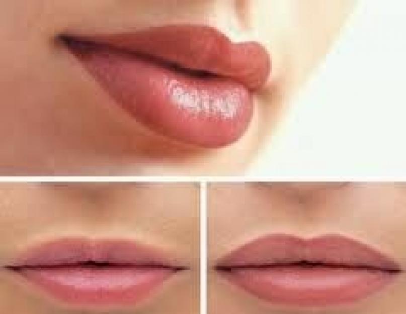 Формы губ после увеличения – результаты различных техник. Меняем форму губ Можно ли гиалуроновой кислотой изменить форму губ