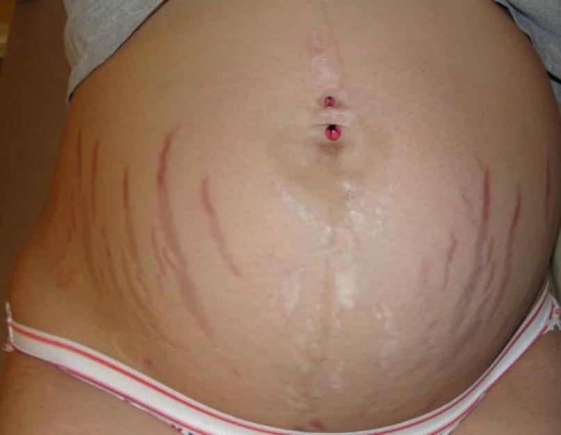 Влияние беременности на кожу и уход за кожей во время беременности. Проблемная кожа во время беременности Общие рекомендации по выбору ухаживающей и декоративной косметики во время беременности