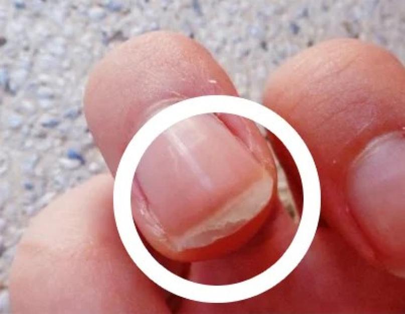 Ногти слоятся и ломаются: лечение в домашних условиях. Болезни ногтей: какими они бывают и как их вылечить Чем можно вылечить больные ногти