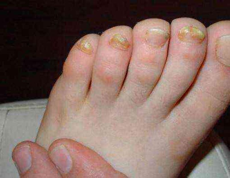 Борьба с грибком ногтей в домашних условиях. Грибок ногтей на ногах: как организовать лечение в домашних условиях современными средствами. Чем лечить грибок в домашних условиях