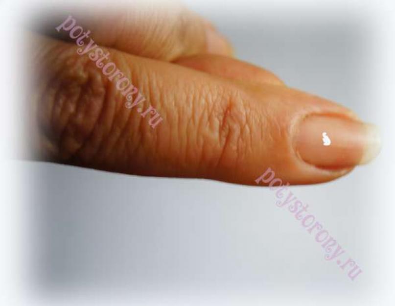 Белые пятнышки на ногтях рук причины. Белые пятна на ногтях рук — что это означает? Белая точка на мизинце