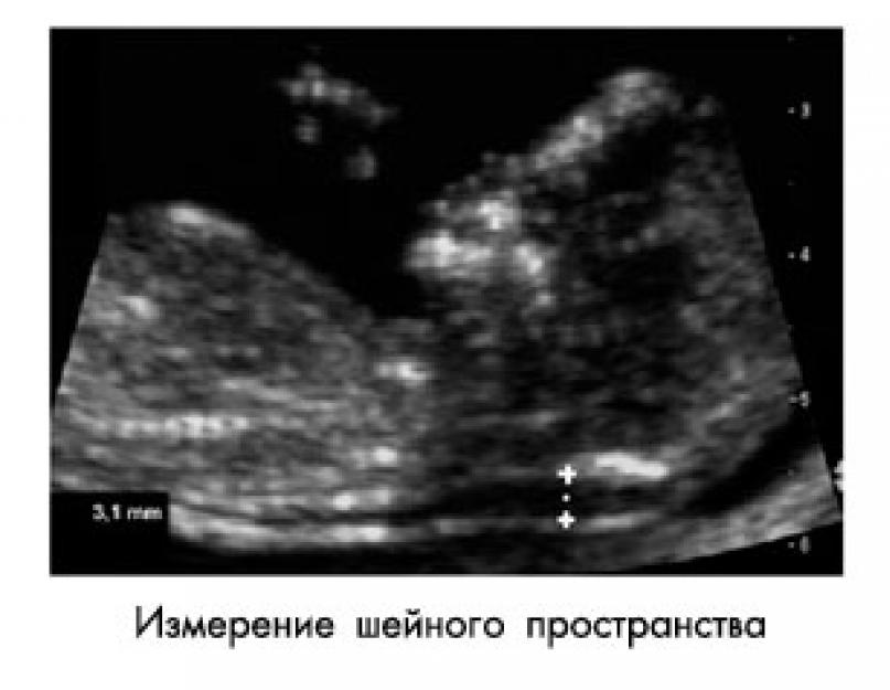 Пренатальный скрининг трисомий II триместра беременности (тройной тест). Беременность - Пренатальный скрининг трисомий II триместра беременности, PRISCA Что такое PAPP-A