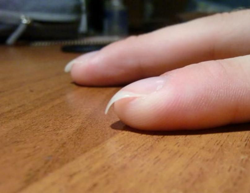 Почему закручиваются ногти на руках. Почему загибаются ногти и что делать для профилактики и восстановления