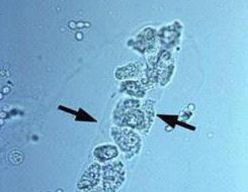 Increased casts in urine.  Hyaline casts in urine.  What do you mean by cylinders?