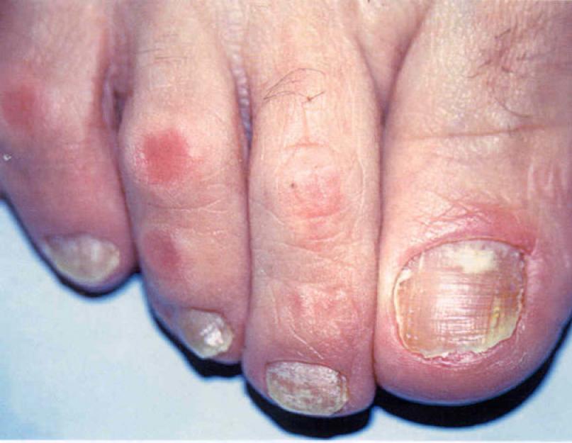 Jak si krásně ostříhat nehty.  Jak si správně ostříhat nehty na nohou?  Zvláštní příležitosti pro stříhání nehtů