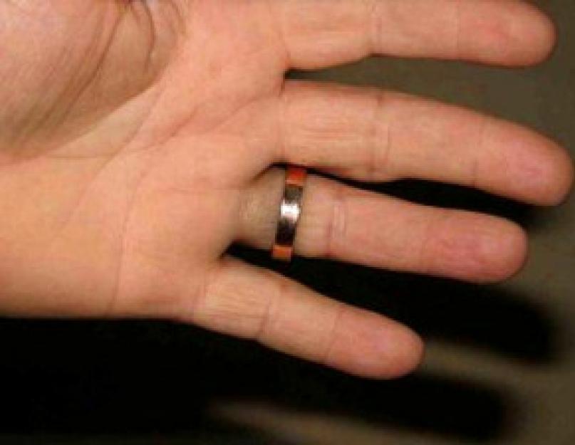 Полоса от золотого кольца. Почернение колец. Отпечаток от кольца на пальце. Кольцо окисляется на пальце.