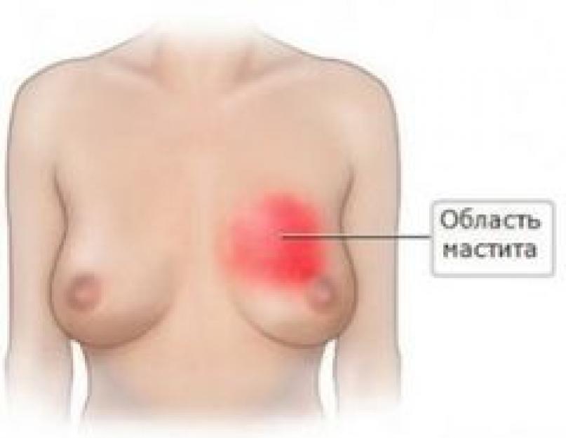 Jeśli matka karmiąca ma objawy przeziębienia piersi. Zapalenie wymienia u kobiet nie karmiących: objawy, przyczyny, leczenie
