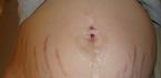 Skóra problematyczna w ciąży Ogólne zalecenia dotyczące wyboru kosmetyków pielęgnacyjnych i dekoracyjnych w czasie ciąży
