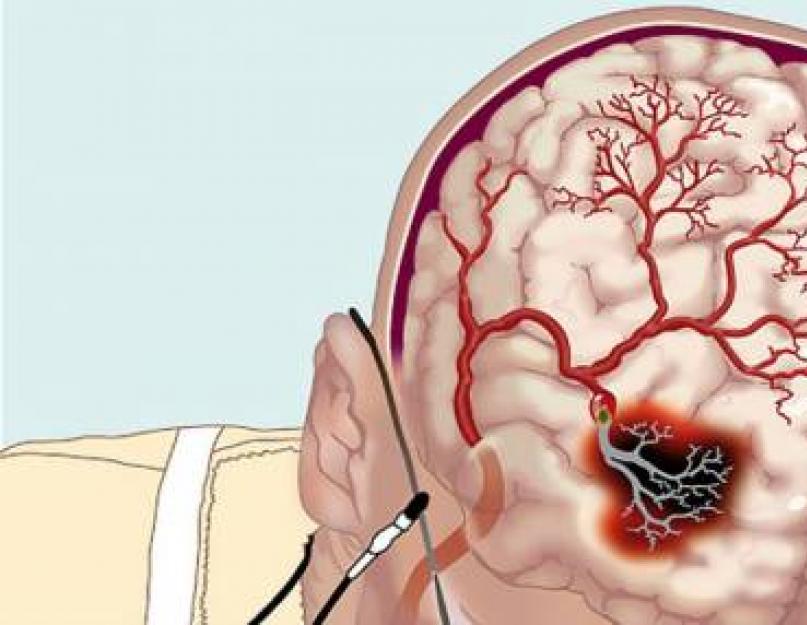Onkologijos (išeminio tipo) simptomai ir požymiai.  Kas yra smegenų infarktas sergant VBB Insultas vertebrobaziliniame regione, kiek jie gyvena?