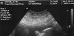 How many weeks of pregnancy is the third ultrasound performed and what indicators are determined?