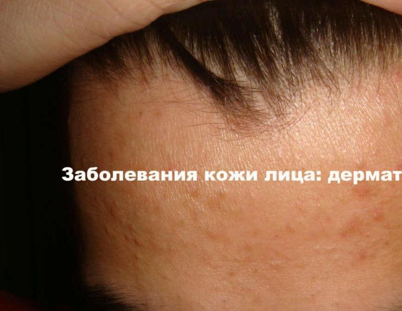 Dlaczego brwi się łuszczą: przyczyny i leczenie u kobiet i mężczyzn.  Dlaczego skóra na czole łuszczy się u dzieci i dorosłych?  Dlaczego u mężczyzn łuszczy się skóra na czole?