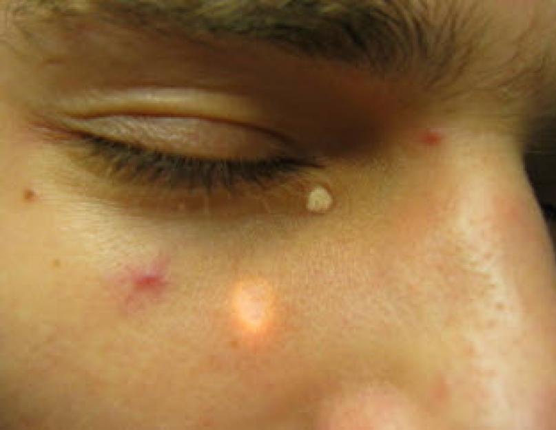White thing under the skin on the face. Five Reasons Why Little White Pimples Are On Your Face and How to Get Rid of Them White dots: types and symptoms
